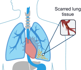Asbestosis
