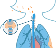 Laryngeal Cancer
